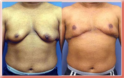 breast reduction photos. patient. Before