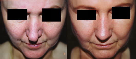 Before and After Rhinoplasty - Nose Surgery for Pinched Tip in Los Angeles